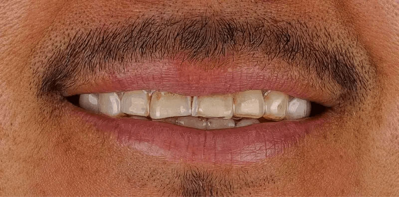 Before dental treatment at Central Washington Dental Care